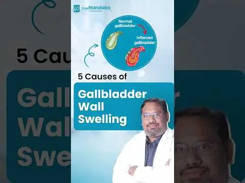 5 Causes of Gall Bladder Wall Swelling | Treatment for Gallbladder Stone in Hyderabad |