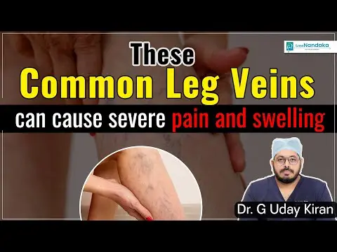 Varicose Veins: Symptoms, Risk Factors ,Treatment | Blue Veins in Legs |